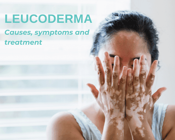 Leucoderma-Causes-symptoms-and-treatment.png