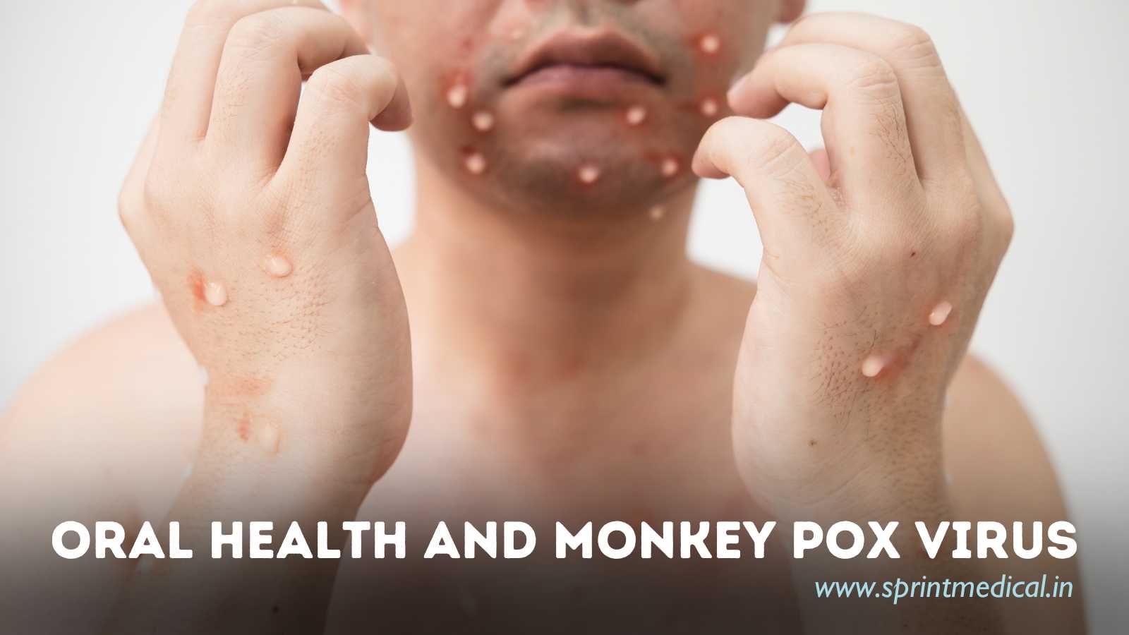 Oral-Health-and-Monkey-Pox-Virus.jpg