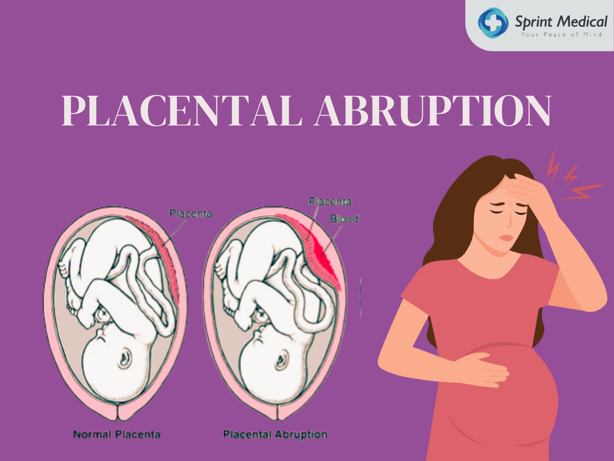 Placental-Abruption.png
