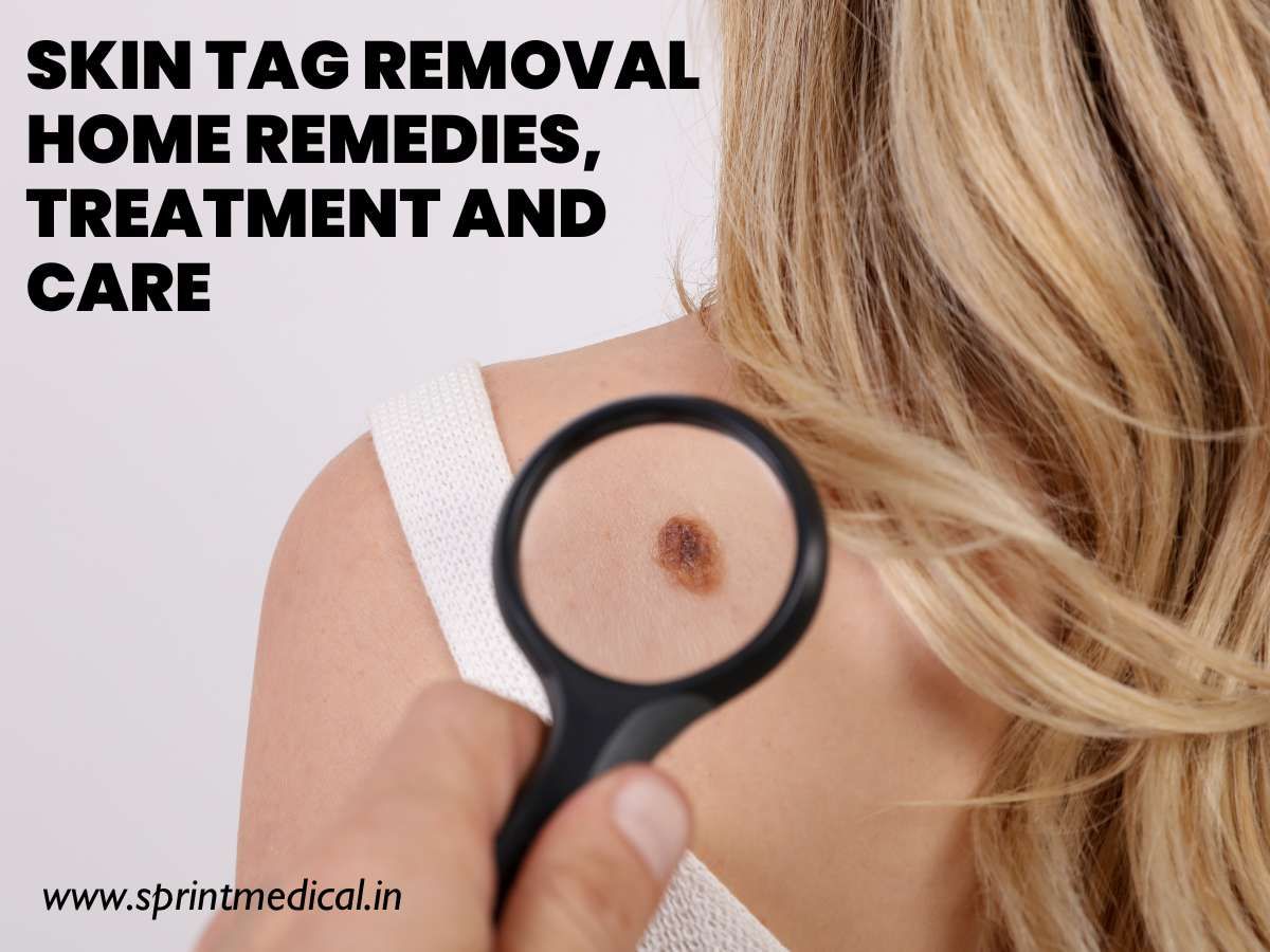 Skin-Tag-Removal-Home-Remedies-Treatment-and-Care.jpg